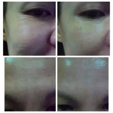 ลดริ้วรอยรอบดวงตา