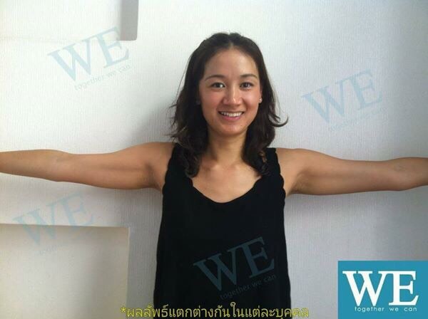 ลดต้นแขน