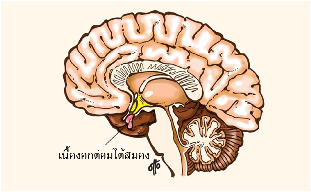 อาการคุชชิ่งแม้ไม่ได้กินยาสเตียรอยด์ก็เป็นได้ หากเกิดเนื้องอกต่อมใต้สมอง