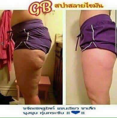 ลดเซลลูไลท์