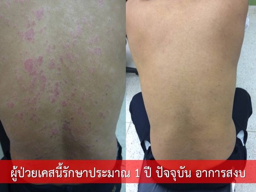 สธ. หนุนใช้แพทย์แผนไทยรักษาโรคสะเก็ดเงิน ได้ผลดี