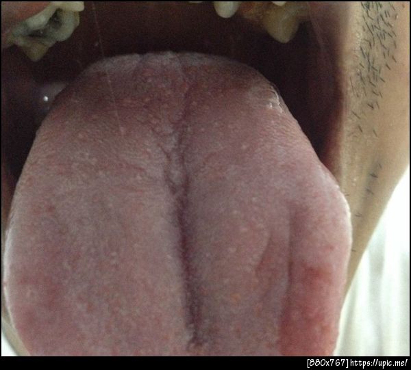 ลิ้นมีตุ่มและมีฝ้า