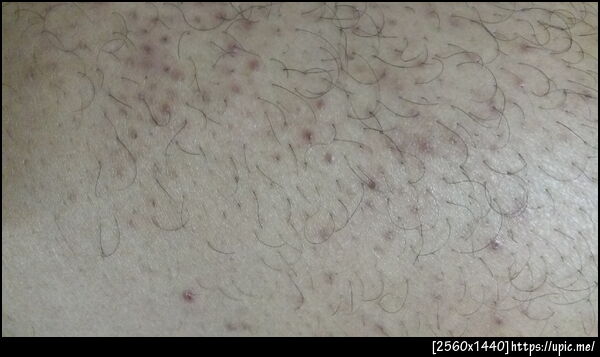 ตุ่มที่ขาครับ