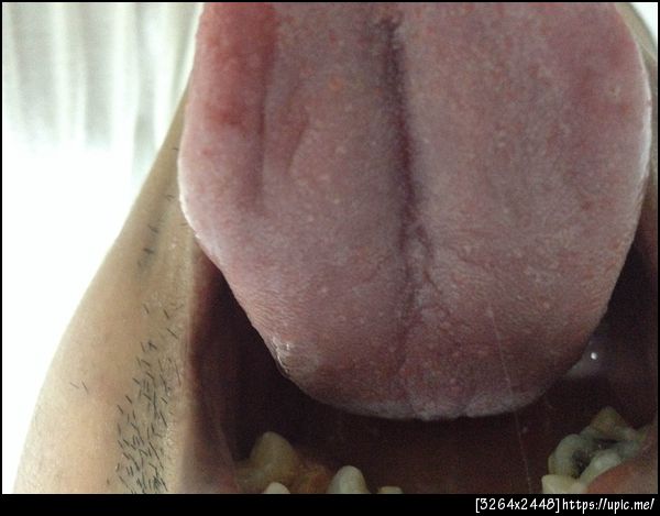 ลิ้นมีตุ่มและมีฝ้า