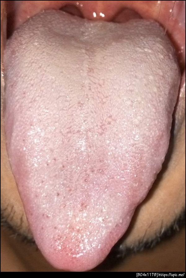 ลิ้นเป็นฝ้าจะเยอะบริเวณโคนลิ้น ส่วนกระพุ้งแก้มกับบนเพดานไม่มี เป็นที่ลิ้นอย่างเดียว