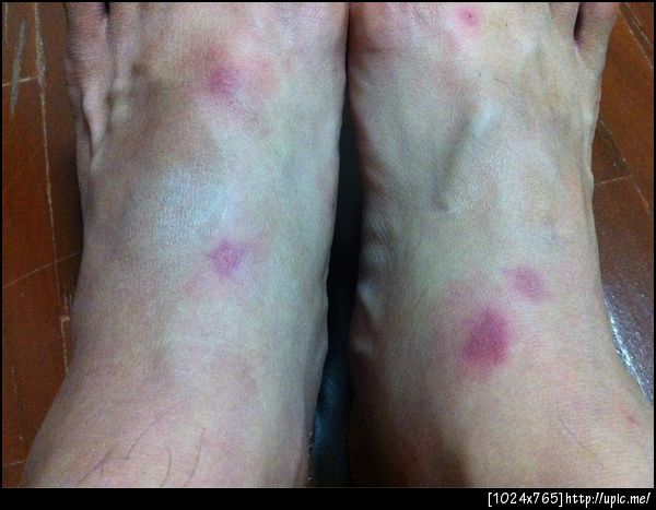 ไปทะเลโดนหมัดกัด ไปดอยโดนเห็บกัด อารายกันนักหนาาา -__-"