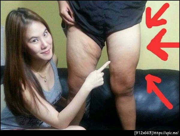 ลดเซลลูไลท์