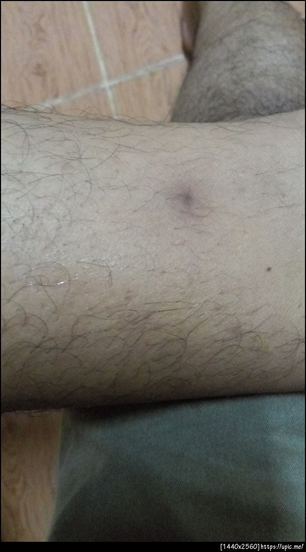 ถ้าหายแล้วจะเป็นรอยดำคล้ำไม่ยอมหาย