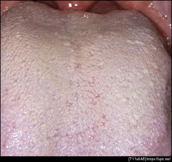 ฝ้าที่ลิ้นครับ