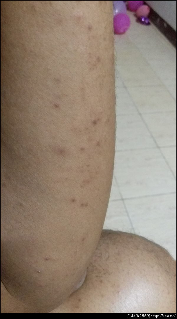 ที่แขนไม่ขึ้นใหม่แล้วแต่ทิ้งรอยไว้