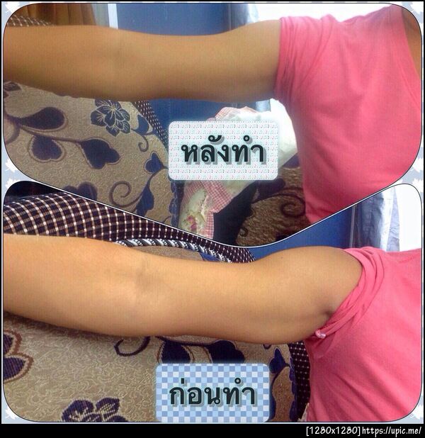 ลดต้นแขน